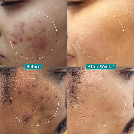 Pilgrim 10% Niacinamide Face Serum For Acne Marks 5